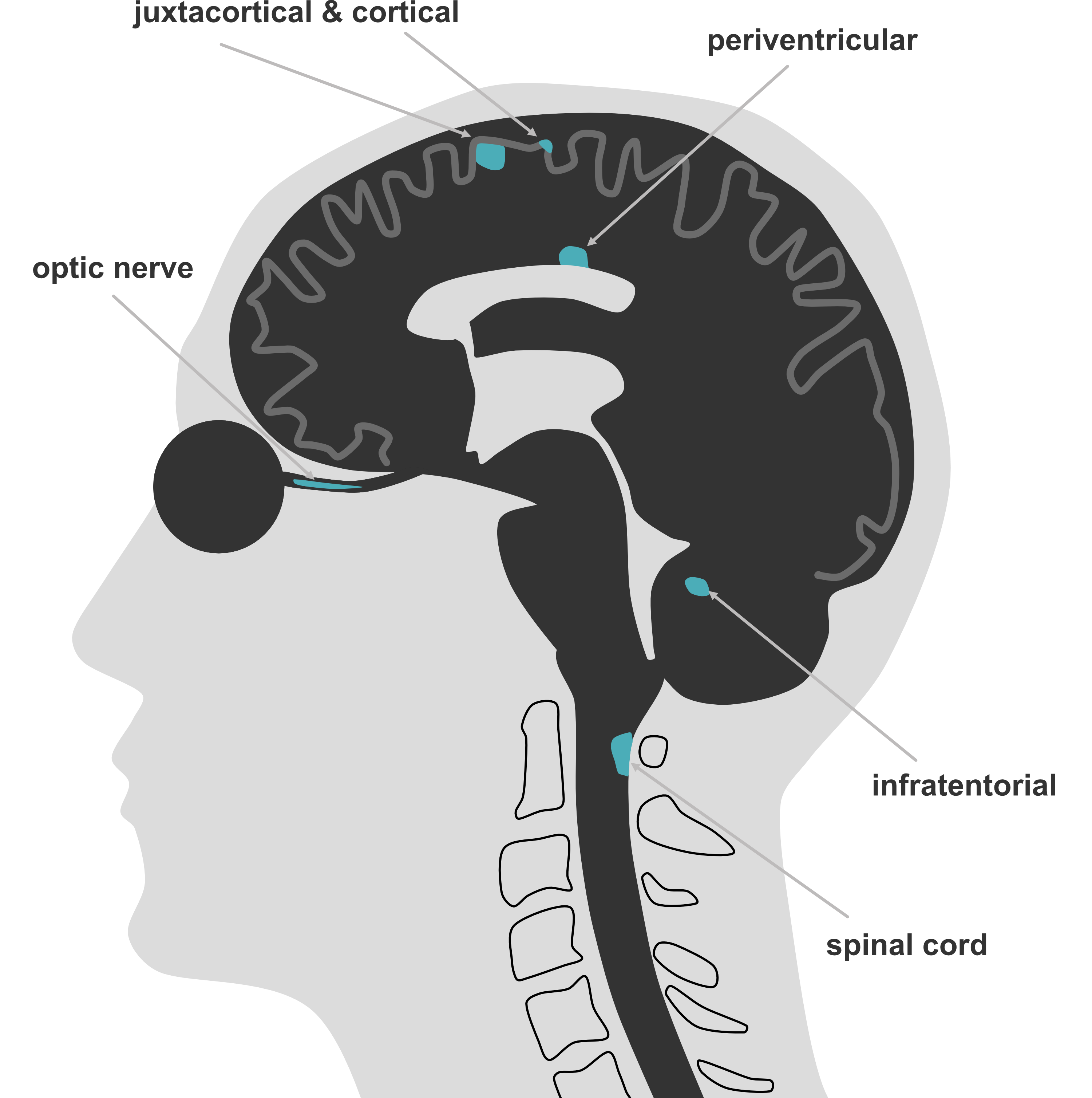 Figure 1.3 - Anatomic regions within the CNS where multiple sclerosis lesions occur.