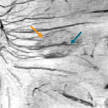 Figure 1.4 - Example of an MS lesion on MRI with a paramagnetic rim (orange arrow) and a central vein (blue arrow). Image from a susceptibility-weighted sequence on a 7T MRI scanner.
