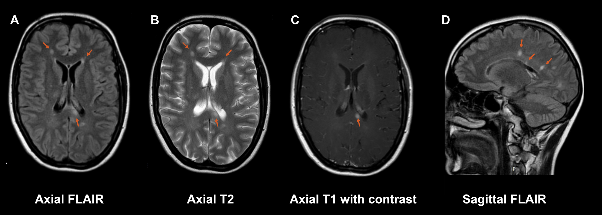 Figure S1.1 - Axial FLAIR (A) and T2 (B) showing periventricular lesions and a corpus callosum lesion, which enhances after contrast on a T1-weighted post-contrast axial sequence (C). Sagittal FLAIR (D) showing periventricular lesions in typical Dawson finger configuration.