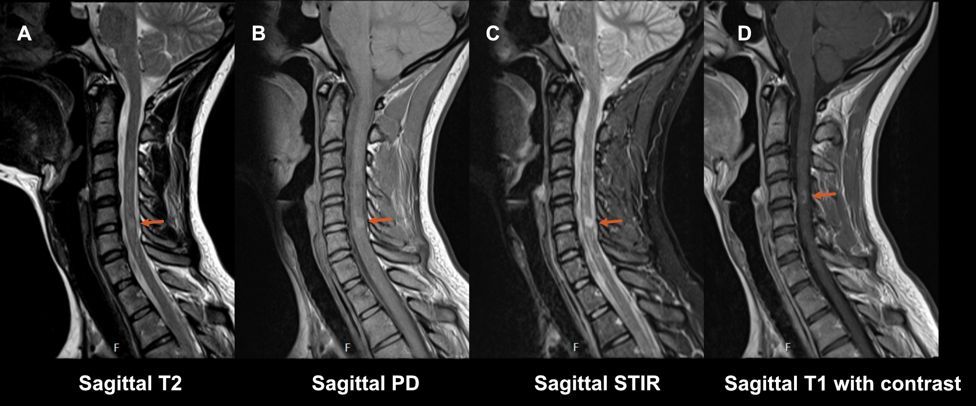 Figure S1.2 - Spinal cord lesion on C5-C6 visible on T2 (A), proton-density weighted (B) and short-tau inversion recovery (C) sequences. Lesion enhancing on a T1 weighted sequence after gadolinium contrast administration (D).